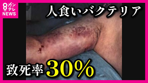 日本突发“食人菌”大爆发，感染过千例，发病到休克最快只需24小时！